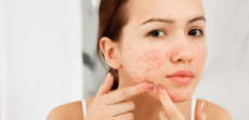 Acne da mulher adulta: qual a causa e como tratar?