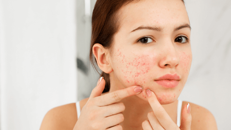 Acne da mulher adulta: qual a causa e como tratar?