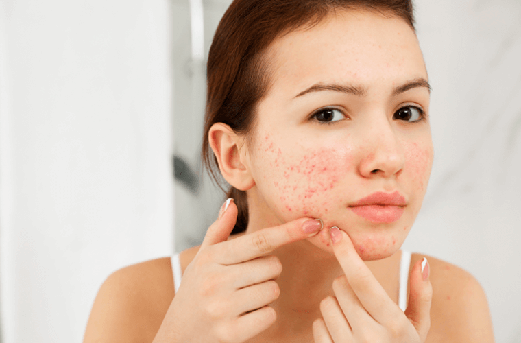 Acne da mulher adulta: qual a causa e como tratar?