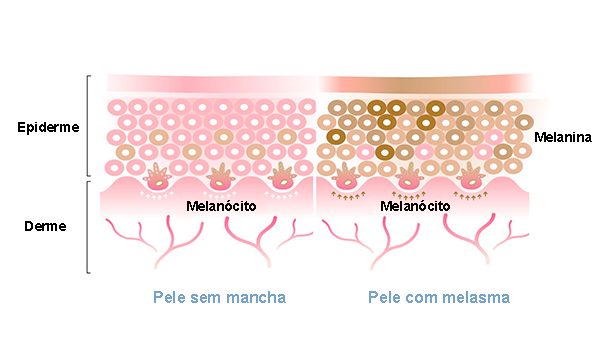 ação do melanócito sobre a melanina no melasma